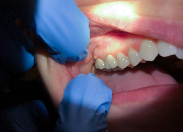 Best Emergency Dental Care for Broken or Chipped Teeth in Clarksville, VA